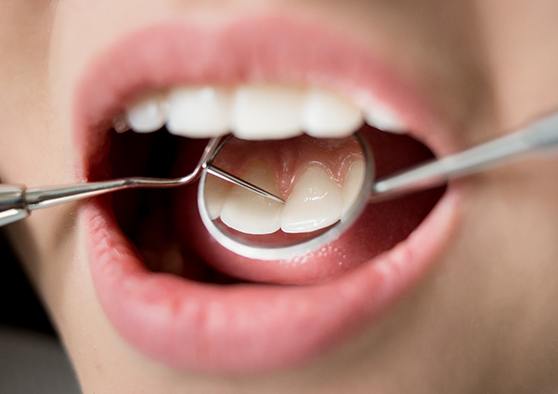 Closeup of someone’s top teeth reflected in dental mirror during exam