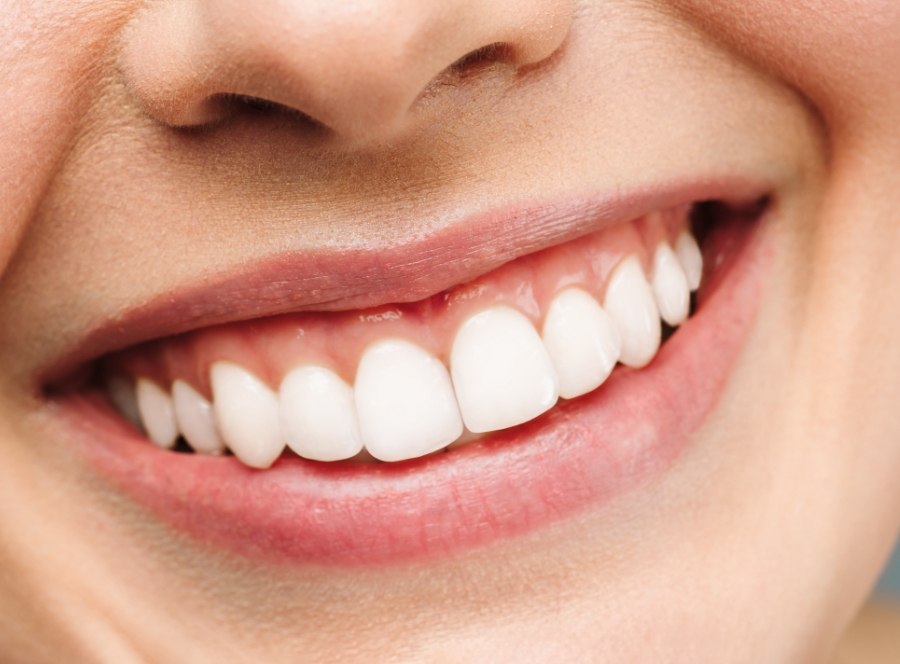 Flawless smile after cosmetic dentistry