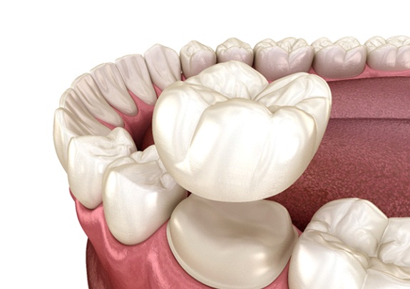 Diagram showing how dental crowns in Lincoln work