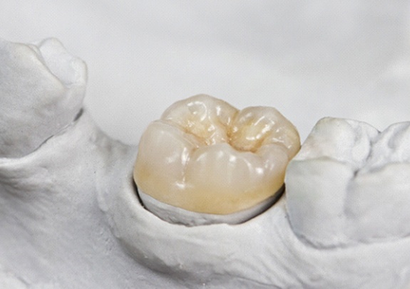 Dental crown sitting in a dental mold