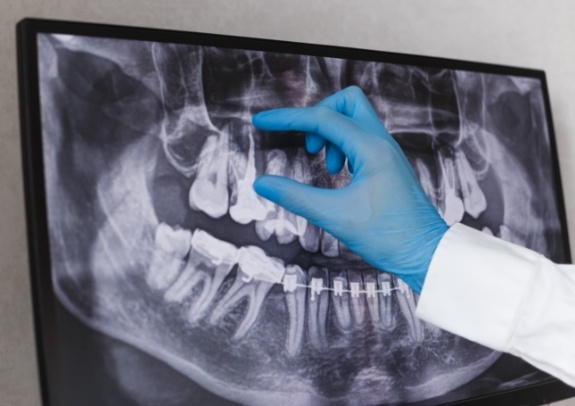 Digital dental x-rays