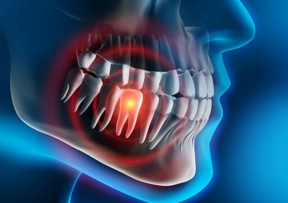 Animated smile with highlighted tooth in need of emergency dentistry