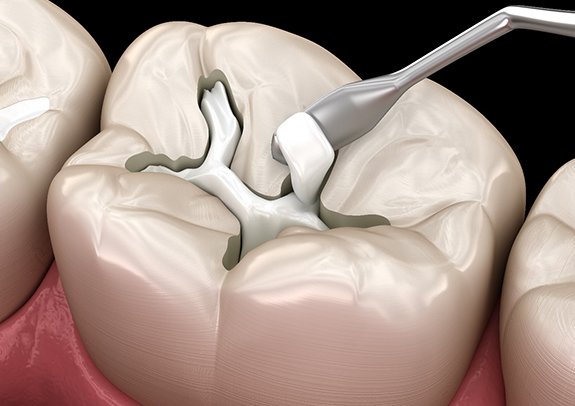 Illustration of applying a tooth-colored filling in Lincoln, NE