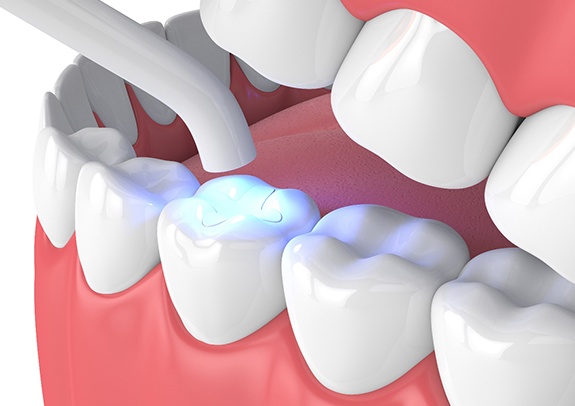 Render of a tooth-colored filling in Lincoln, NE being hardened in place