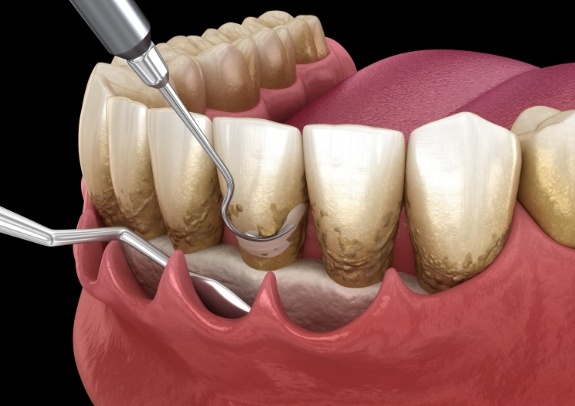 Animated smile with receding gums indicating periodontal disease