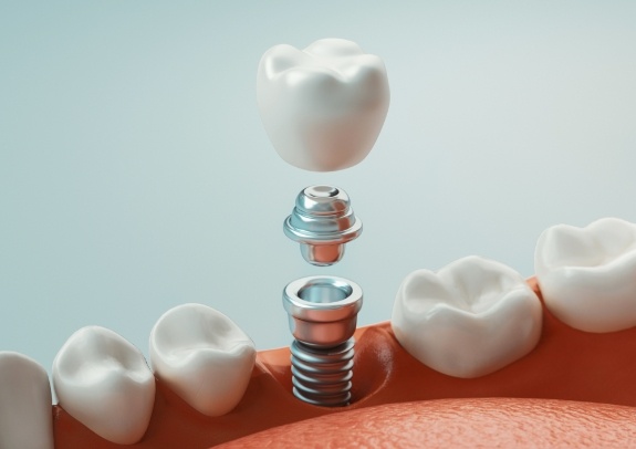 Animated smile during dental implant tooth replacement process