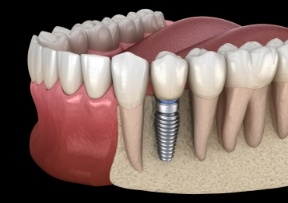 Animated smile during dental implant supported dental crown placement