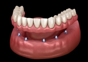 Animated smiling during dental implant supported denture placement