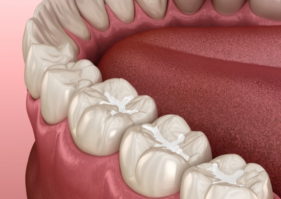 Animated smile with dental sealants