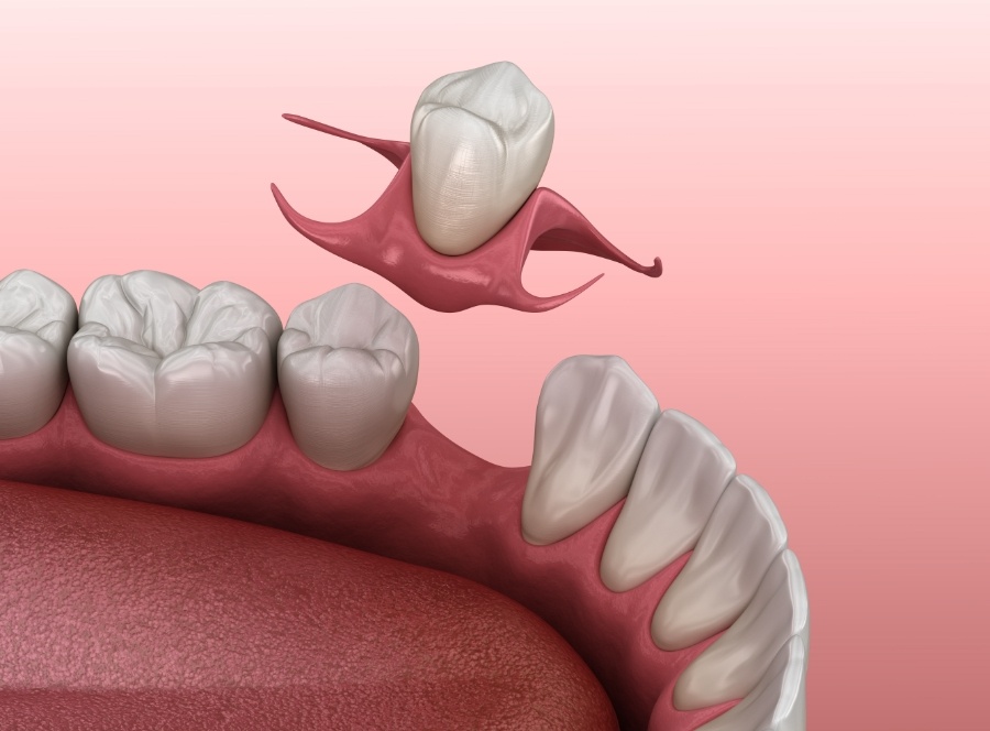 Animated smile during tooth replacement