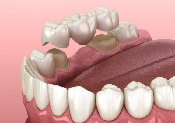 Animated smile during dental bridge placement