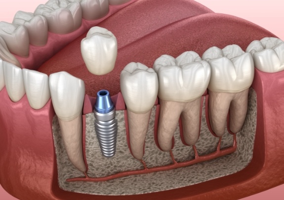 Animated smile during dental implant supported dental crown placement