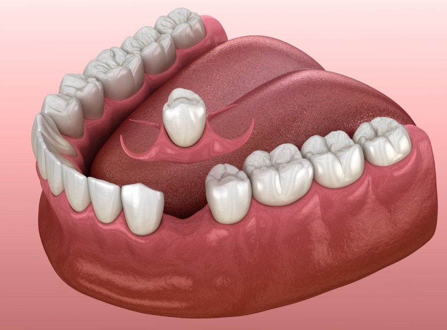 Animated smile during restorative dentistry treatment