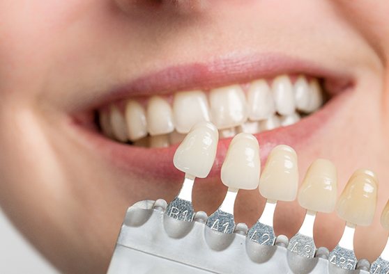 Color match card held up to teeth