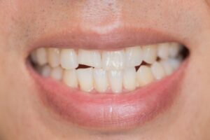 Person with a broken tooth